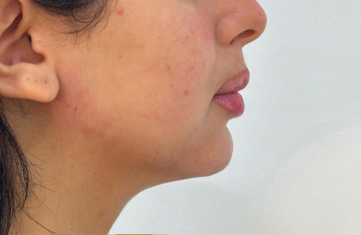 Treatment by Dr. Batoul Reffai