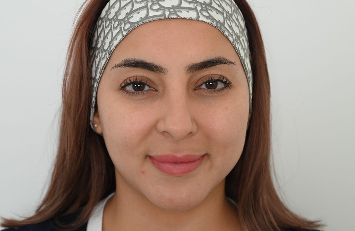 Before jovena treatment