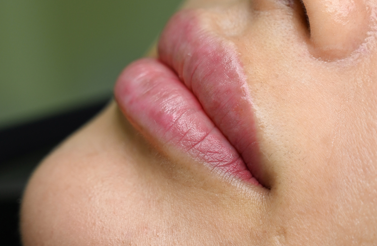 Before lip filler treatment