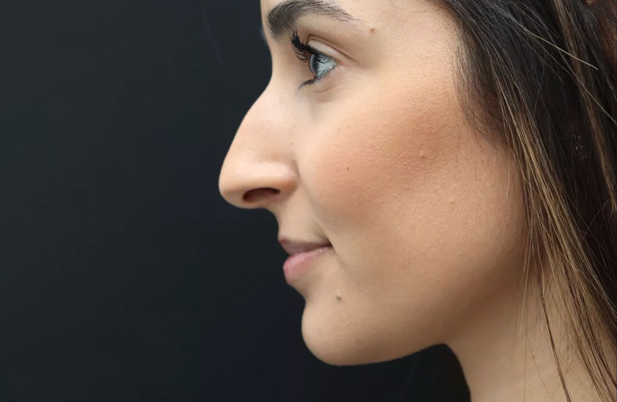 Before rhinoplasty treatment